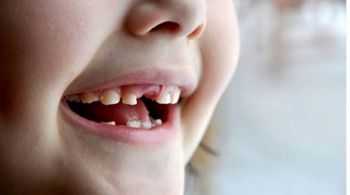 Is bubba at risk of getting baby bottle tooth decay?