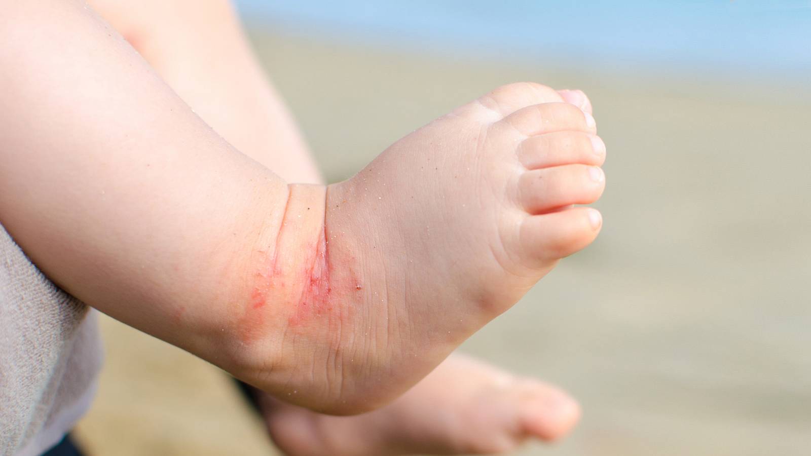 Babies-6-things-you-didn't-know-about-eczema1