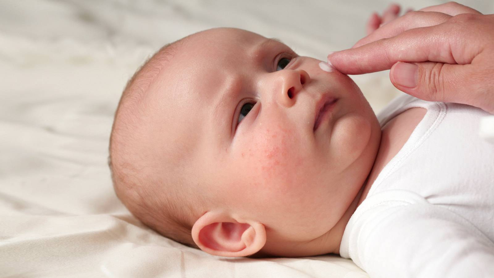 Babies-6-things-you-didn't-know-about-eczema3