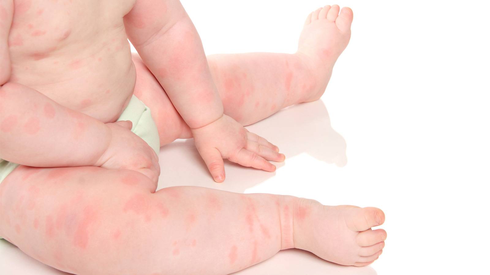 Babies--Baby-allergies-What-you-need-to-know
