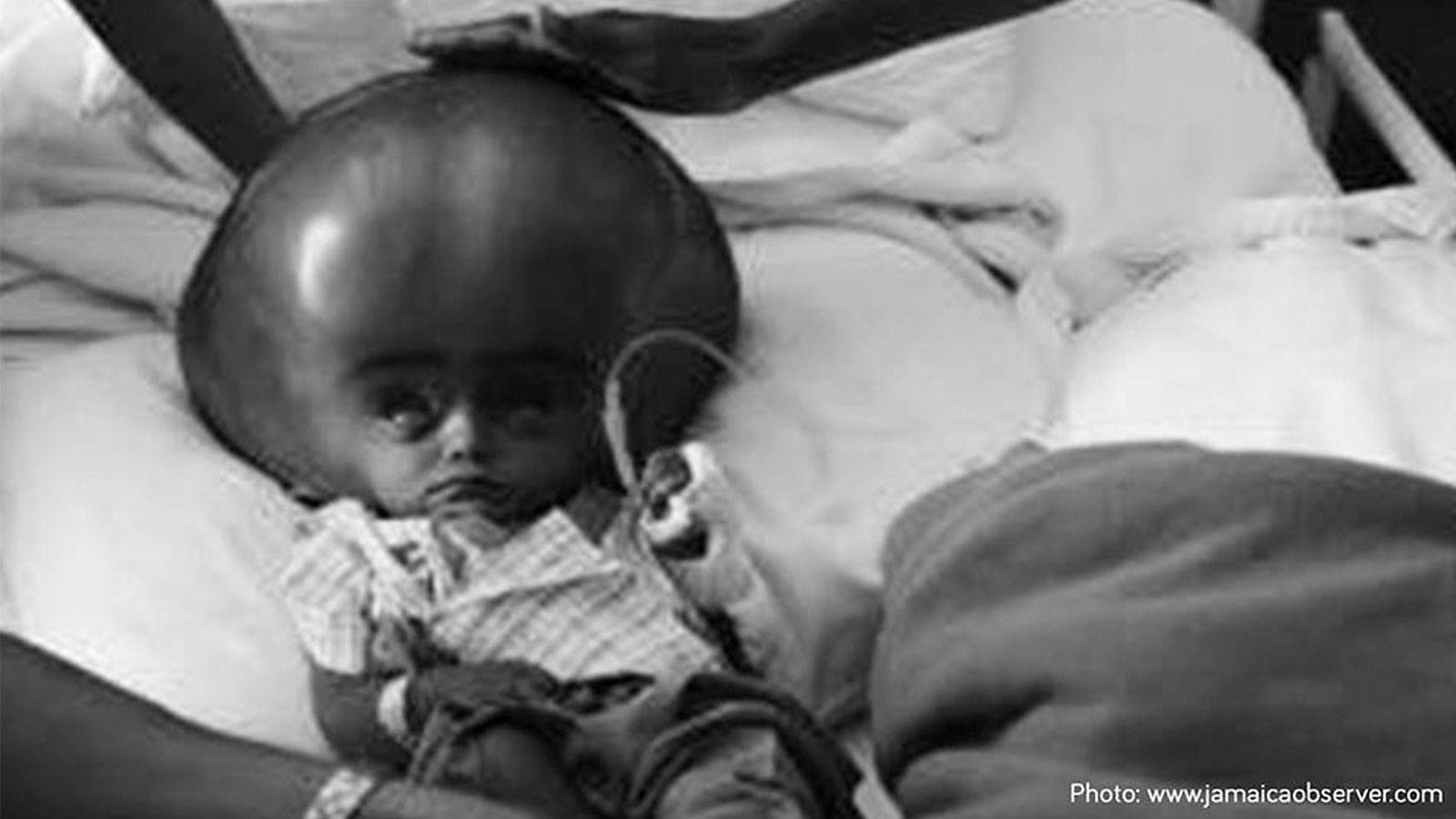 Babies-EXPERT-ADVICE-What's-that-growth-on-my-baby's-back-2