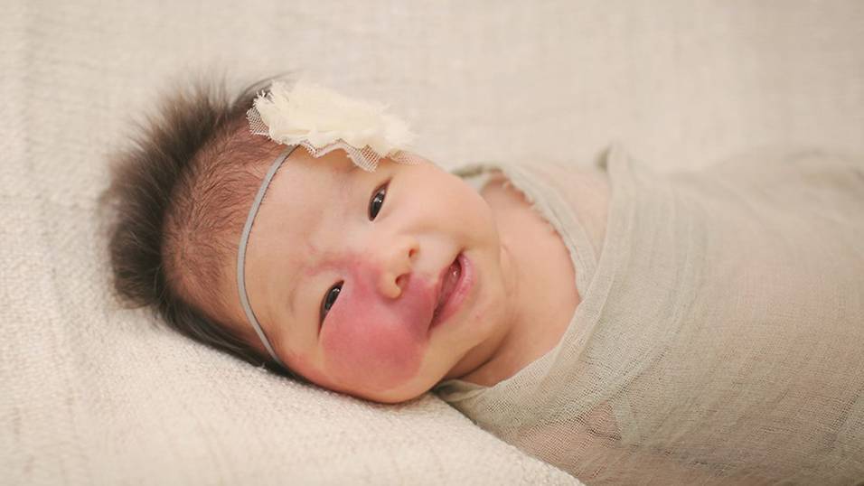 My little girl's birthmark covers half her face!