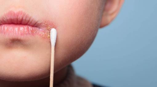 Kids-EXPERT-ADVICE-How-do-I-get-rid-of-my-cold-sore-MAIN